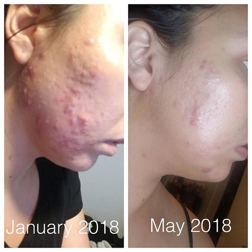 Sérum Anti-Acné Bio — Peau Nette en 2 Semaines ✨